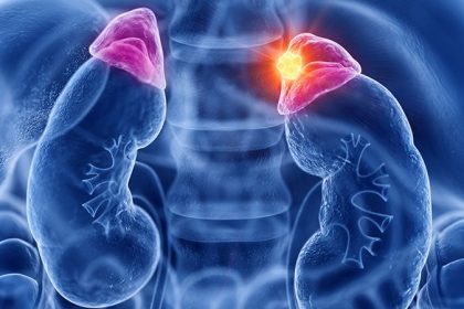 Surgery Treats Hypertension in Patients With Adrenal Tumours