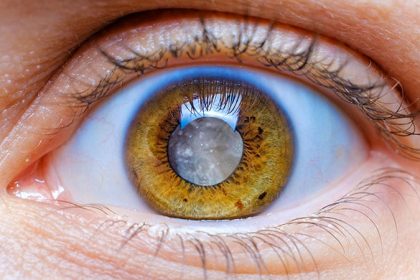 Office-Based Cataract Surgery Measures Up To ASC Cases