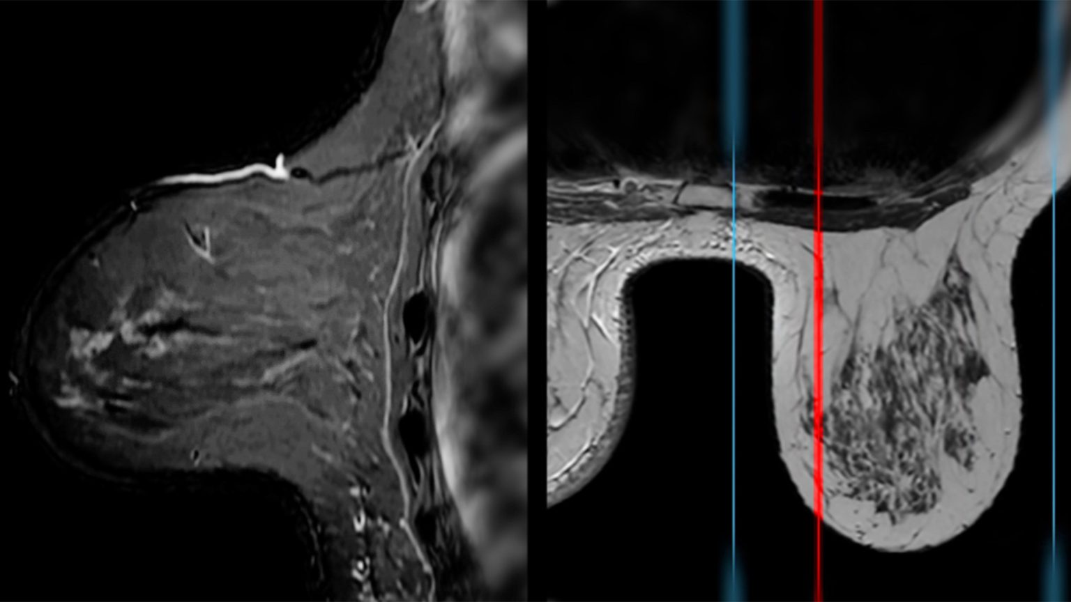 Supplementary Contrast Imaging Techniques for Dense Breasts Better Than Ultrasound