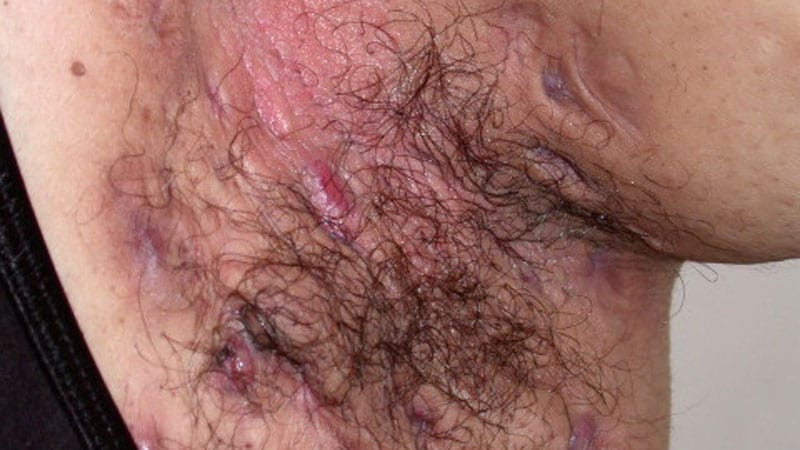 Secukinumab Cuts Chronic Pain in Hidradenitis Suppurativa