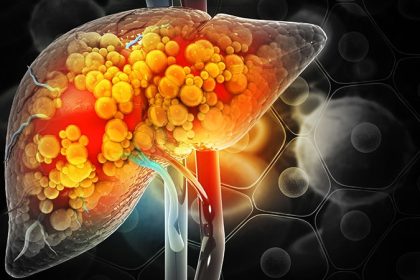 Auto-Brewery Syndrome: Is It Real? And Rare?