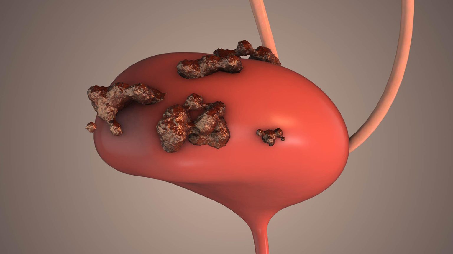 Recent Developments in Bladder Cancer