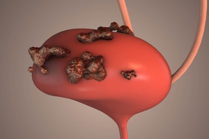 Recent Developments in Bladder Cancer