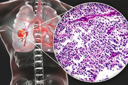 Immune Side Effects Tied to Better SCLC Survival