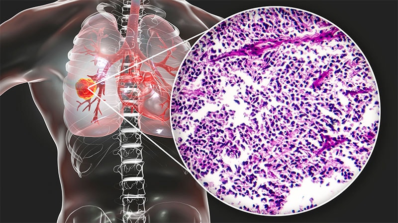 Immune Side Effects Tied to Better SCLC Survival