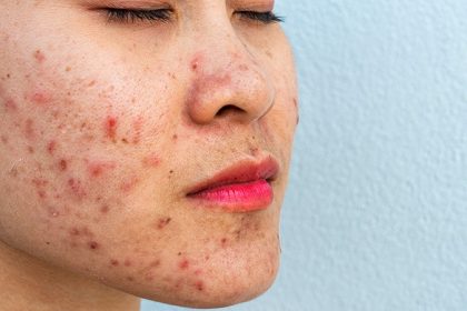 New Acne-Specific Lasers Are Not Identical