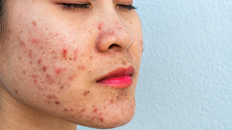 New Acne-Specific Lasers Are Not Identical