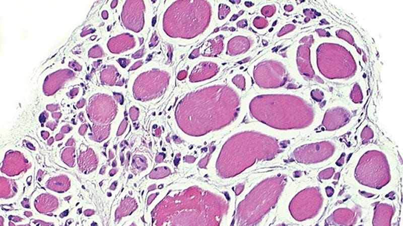 In Heart Failure, Cellular Therapy Is Active