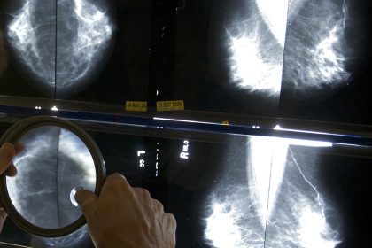 Advanced Cancers Returned to Prepandemic Levels, According to a Reassuring Report