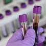 New blood test enables the rapid diagnosis of thousands of rare genetic diseases