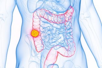 Patients With Early-Onset CRC Navigate Cancer Care Barriers