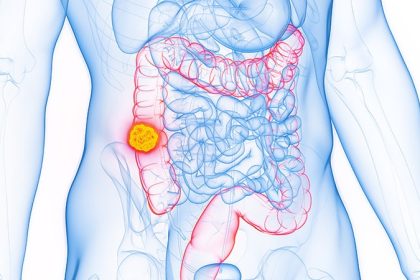 Patients With Early-Onset CRC Navigate Cancer Care Barriers