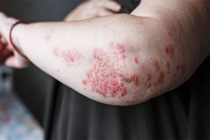 Predictive Factors Shape Guselkumab Response in Psoriasis