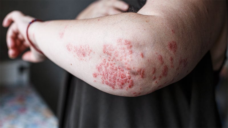 Predictive Factors Shape Guselkumab Response in Psoriasis