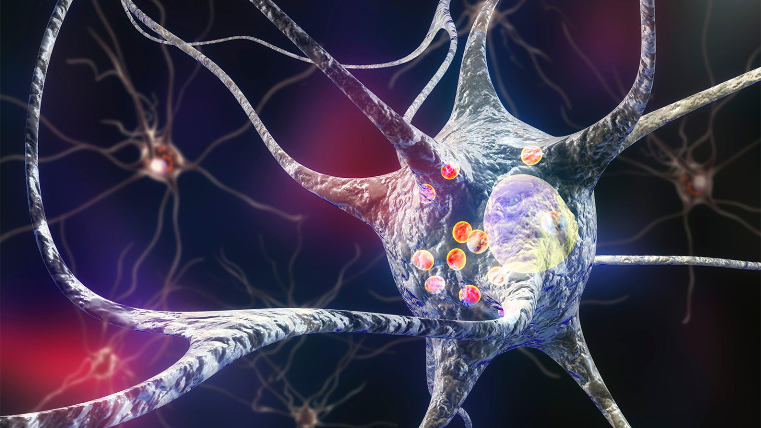 Autism Tied to Early-Onset Parkinson’s Disease