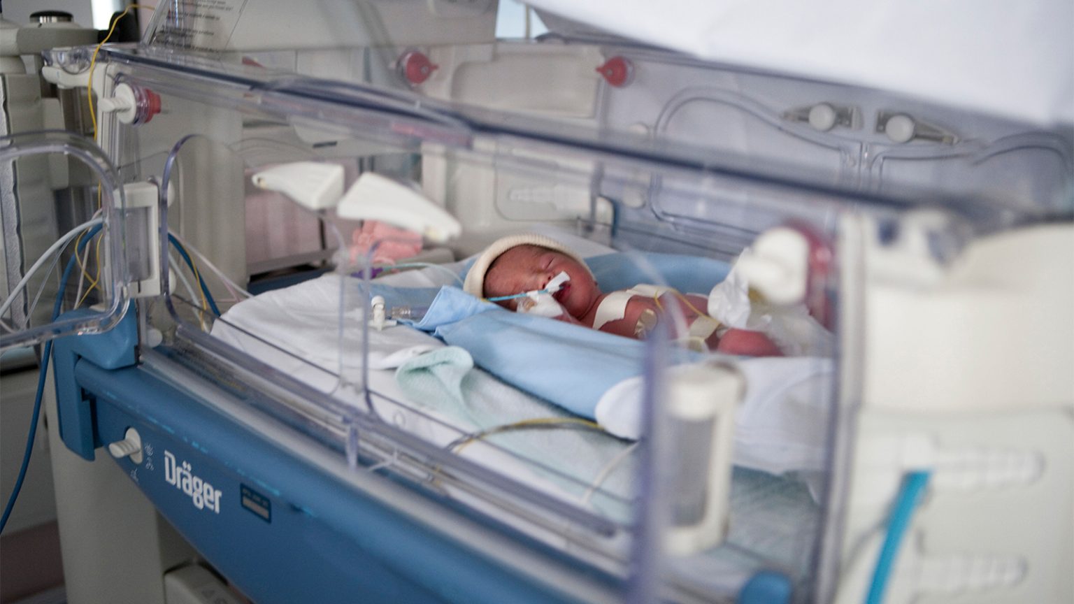Preterm Infants Treated Early for Patent Ductus Arteriosus Had Worse Outcomes