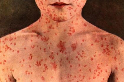 Ontario measles outbreak tops 1,000 cases