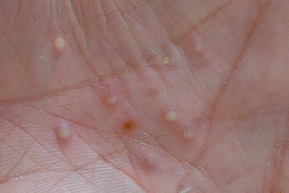 Spesolimab Provides Sustained Improvement of GPP and QOL