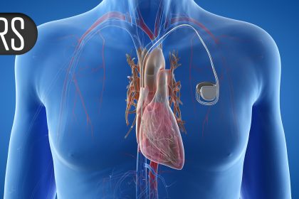 Pulsed Field Ablation’s Safety Challenged by Evidence of Collateral Damage