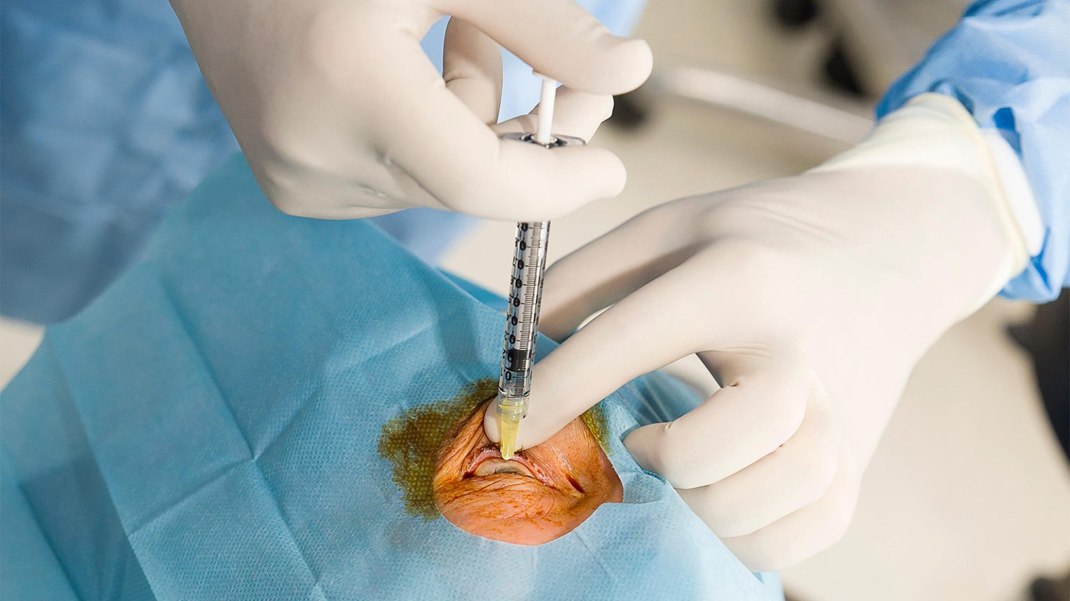 Alternative to Anti-VEGF Shows Safety, Efficacy in Diabetic Macular Edema