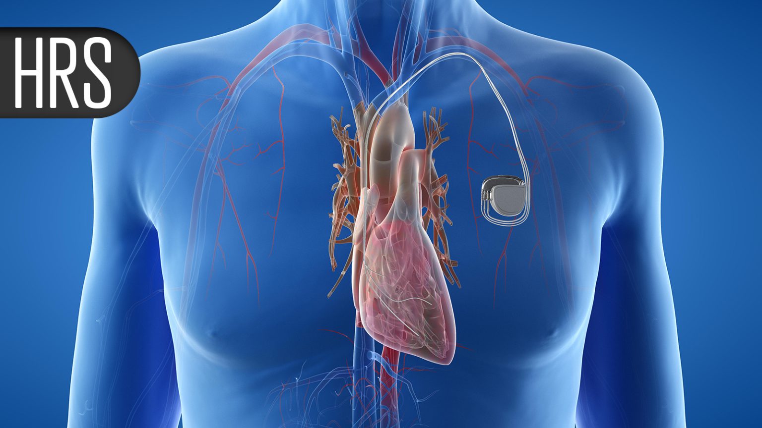 GLP-1 Med Users See Drop in Recurrent Afib Events