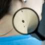 Who should be screened for skin cancer?