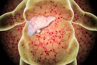 Liver Disease Common in Kids and Teens With Severe Obesity