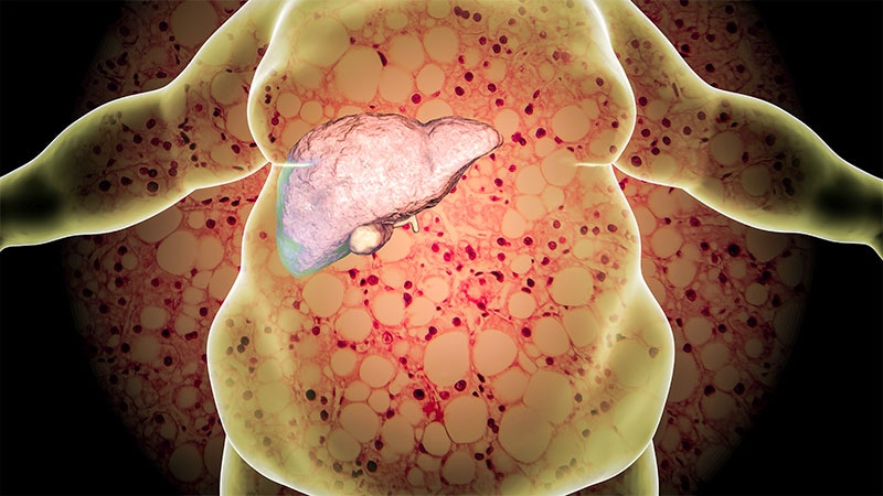 Liver Disease Common in Kids and Teens With Severe Obesity