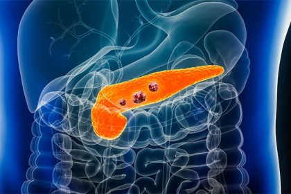Pancreatic, Colorectal Cancer Rising in US Young Adults