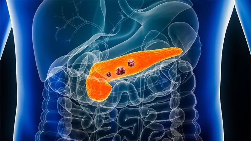 Pancreatic, Colorectal Cancer Rising in US Young Adults
