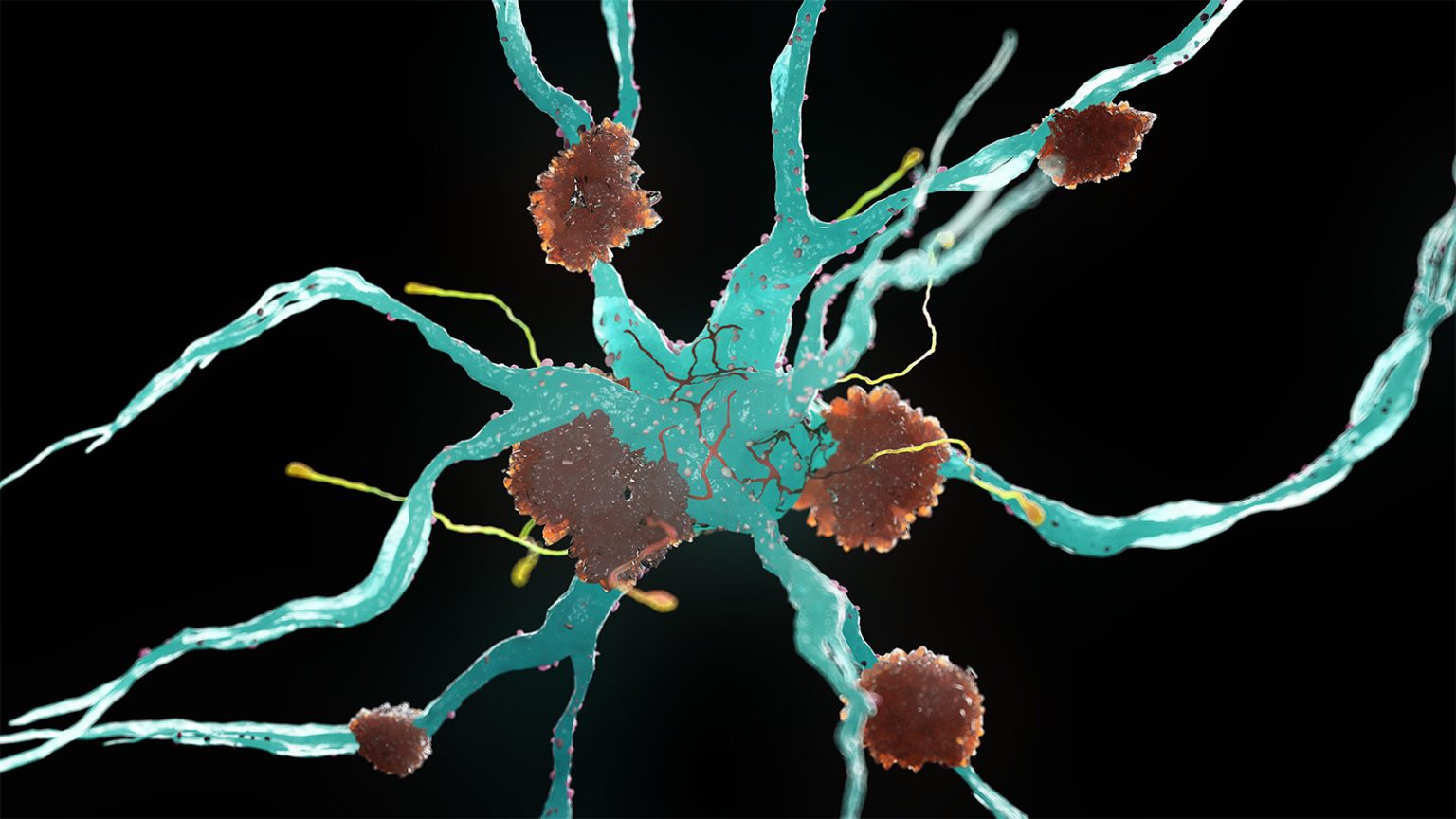 Alzheimer’s Biomarkers Common in People With Other Dementias