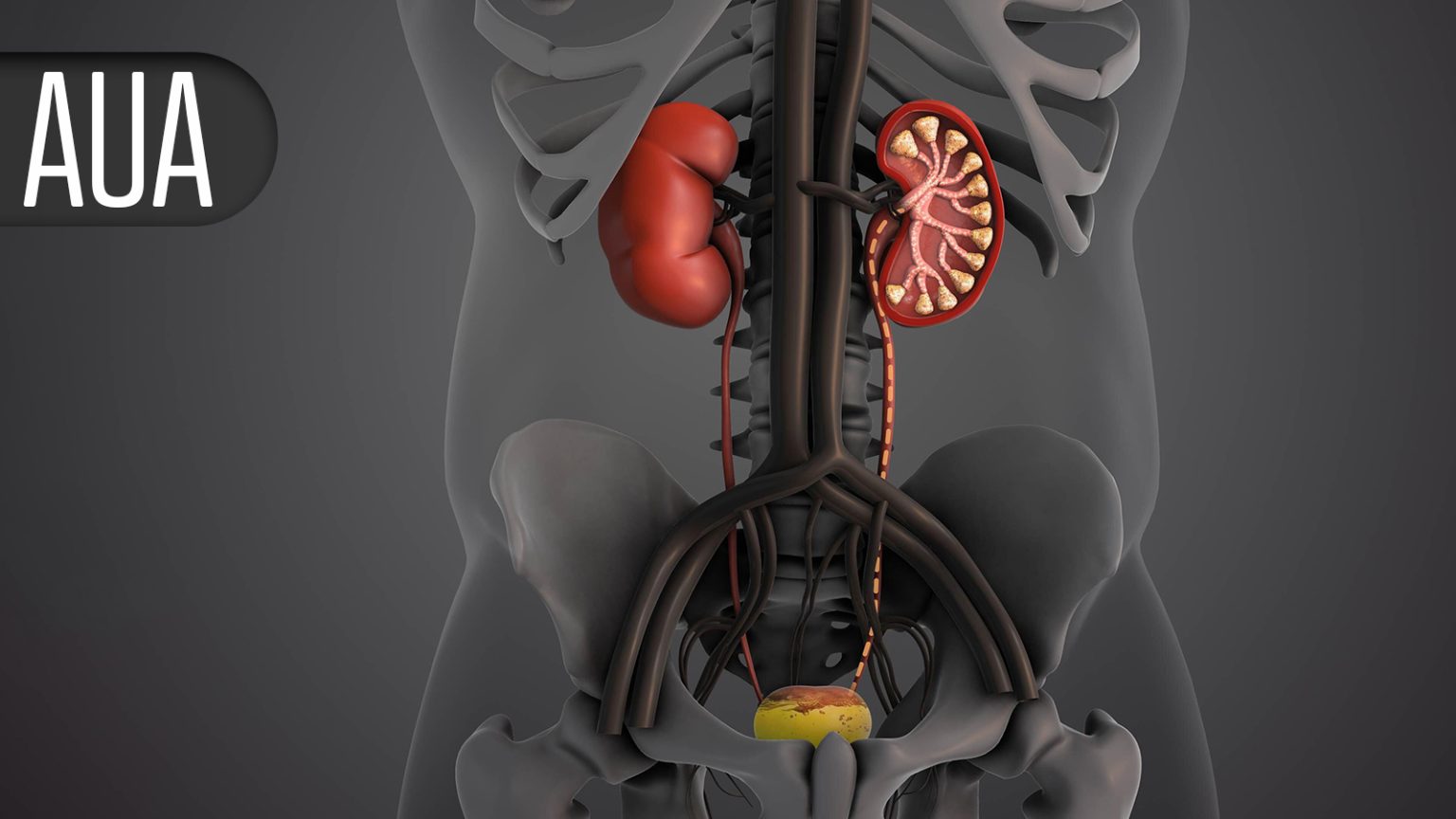 Non-Ablative Intervention for BPH/LUTS Reduces Symptoms With Low Retreatment Rate