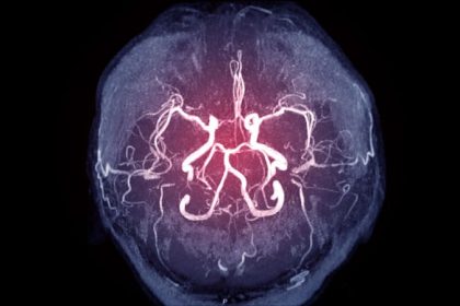 Novel Algorithm Boosts Stroke Triage, Outcomes Across the US