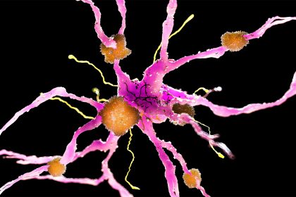 Alzheimer’s Prevalence Tops 7 Million for the First Time