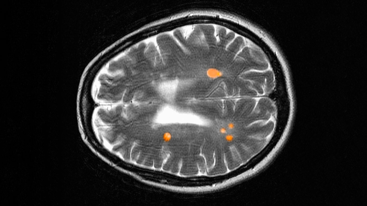 Long-Term Benefits of Anti-CD20 Drugs in Relapsing MS