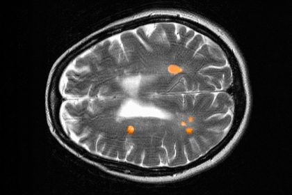 Long-Term Benefits of Anti-CD20 Drugs in Relapsing MS