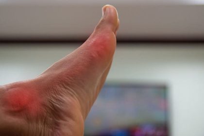 Real-World Data Support Febuxostat’s Cardiovascular Safety