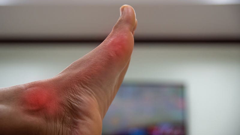 Real-World Data Support Febuxostat’s Cardiovascular Safety