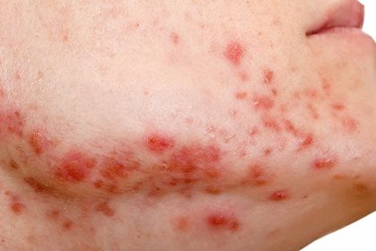 Topical BRAF Inhibitor Relieves Anti-EGFR–Induced Skin Rash