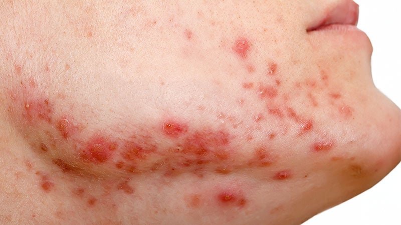 Topical BRAF Inhibitor Relieves Anti-EGFR–Induced Skin Rash
