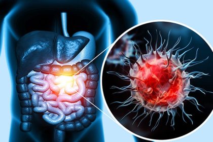 Atezolizumab + Chemo Improves Colon Cancer Survival