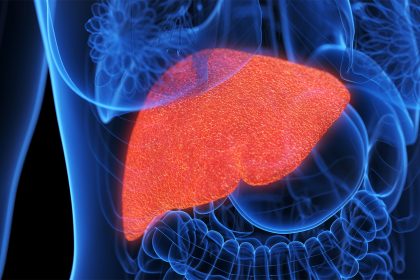 SGLT2 Inhibitor Shows Promise as MASH Treatment