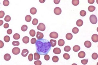PVEK: New Standard of Care in Rare, Deadly Blood Cancer?