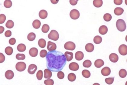 PVEK: New Standard of Care in Rare, Deadly Blood Cancer?
