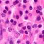 Single-dose CAR-T therapy potentially curative in multiple myeloma