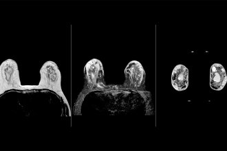 AI-Directed Breast MRI Could Lead to Faster Scan Times Without Affecting Accuracy
