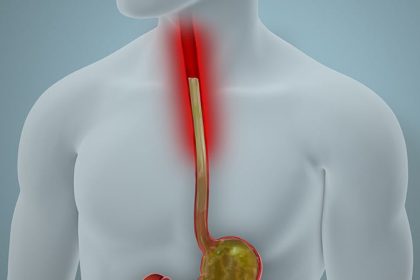 Less Invasive Screening May Identify Barrett’s Earlier