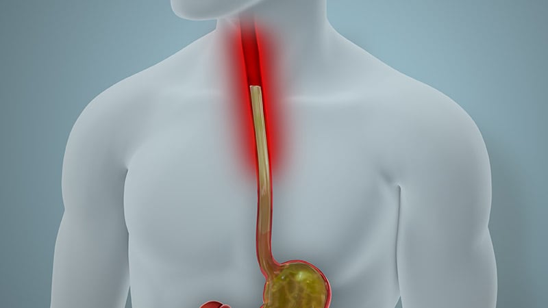 Less Invasive Screening May Identify Barrett’s Earlier