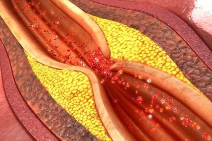 Low-Dose Colchicine May Help Stabilize Coronary Plaques