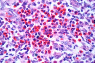 Can New Combo Fill ‘Unmet Need’ in R/R Hodgkin Lymphoma?